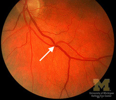 hypertensive retinopathy pdf
